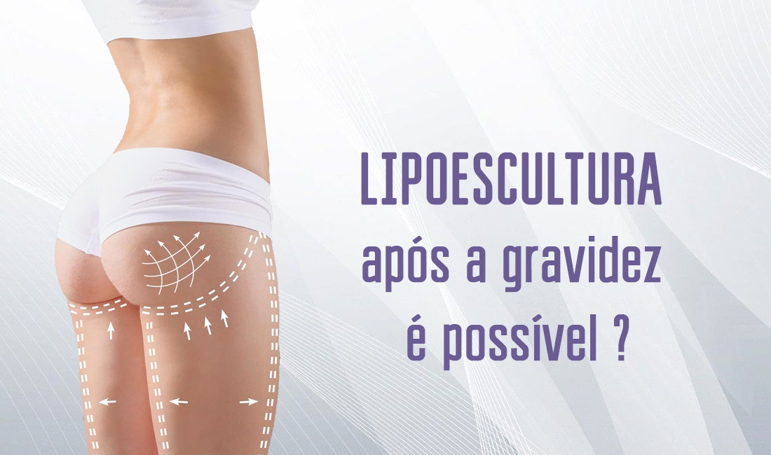 Lipoescultura após a gravidez é possível ? Lipoescultura após a gravidez é possível ?