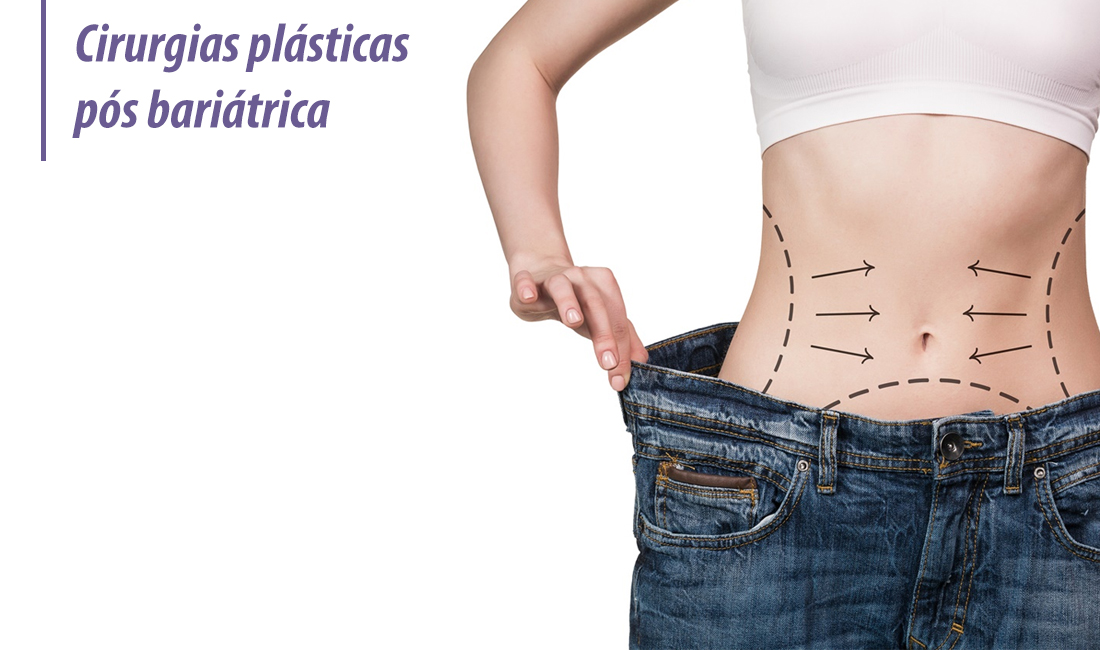 Cirurgias plásticas pós bariátrica Cirurgias plásticas pós bariátrica