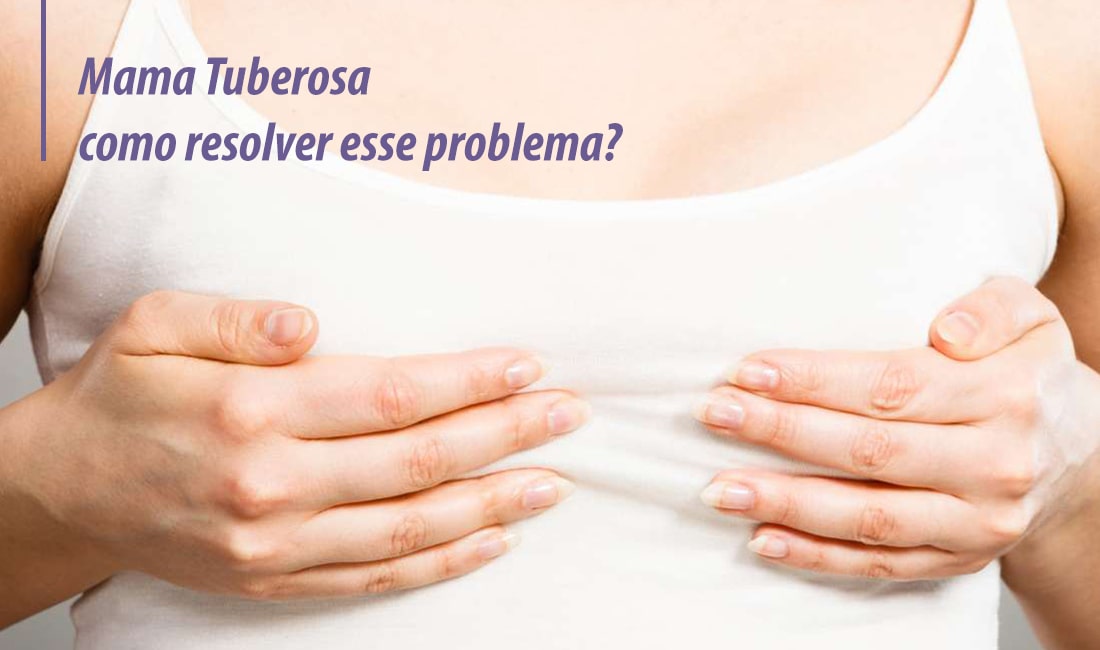 O que é mama tuberosa? O que é mama tuberosa?
