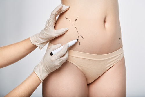 Cirurgia em Ex-Obesos, são procedimentos que exigem alta técnica e cuidado para que sejam executadas com perfeição. Conheça as Cirurgias que executamos através dos exemplos abaixo.