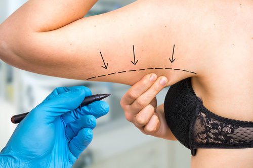 cirurgia-em-ex-obesos
